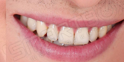 dummy_smile3_after