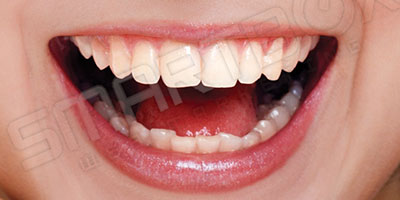 dummy_smile1_after
