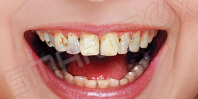 dummy_smile1_before