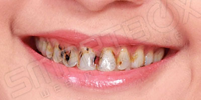 dummy_smile2_before