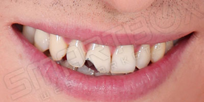 dummy_smile3_before